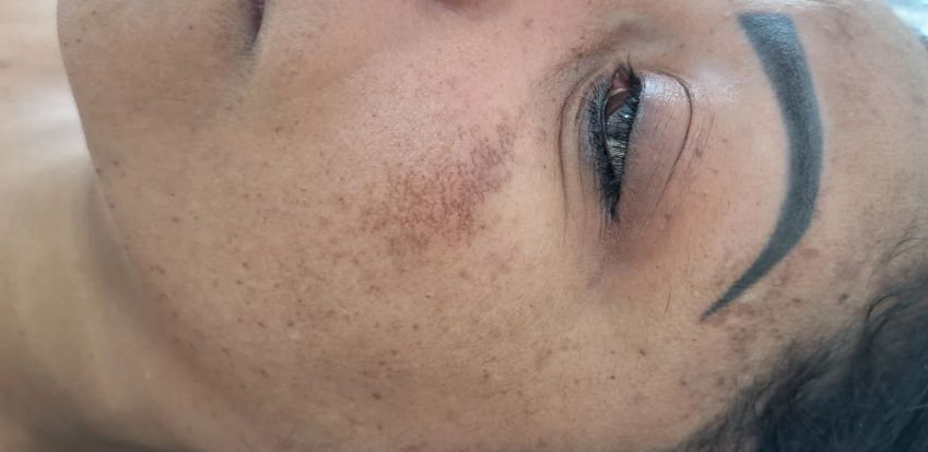 Pele com manchas de melasma antes do tratamento
