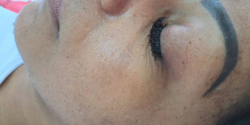 Pele depois do tratamento para melasma, com as manchas mais claras